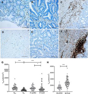 Low Concordance Between T-Cell Densities in Matched Primary Tumors and Liver Metastases in Microsatellite Stable Colorectal Cancer